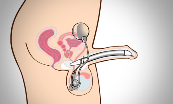 액체가 음낭의 실린더로 이동되면서 발기가 이루어집니다.
